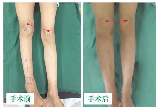 女孩墜梯右腿縮短5cm，幸得醫(yī)生及時(shí)診治恢復(fù)正常腿型