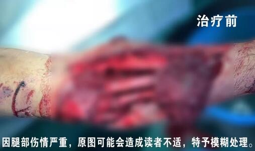 感謝安利醫(yī)院挽救了我的腿，沒(méi)有讓我落下殘疾……”