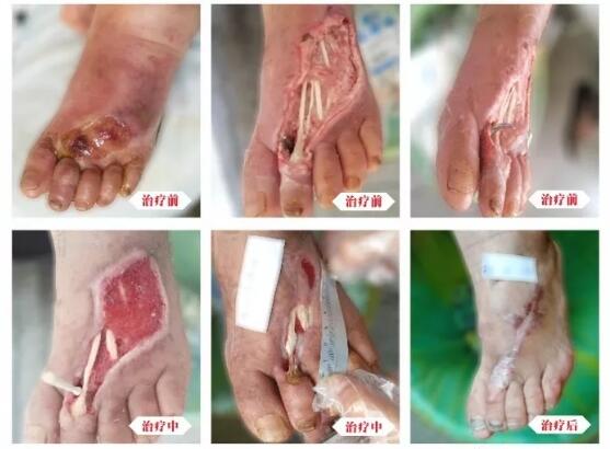 糖尿病并發(fā)癥有多可怕，及時(shí)治療糖尿病足避免截肢！