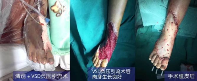 車禍猛如虎，救治如“華佗” ，手術＋康復，8歲小女孩車禍后日漸康復行走