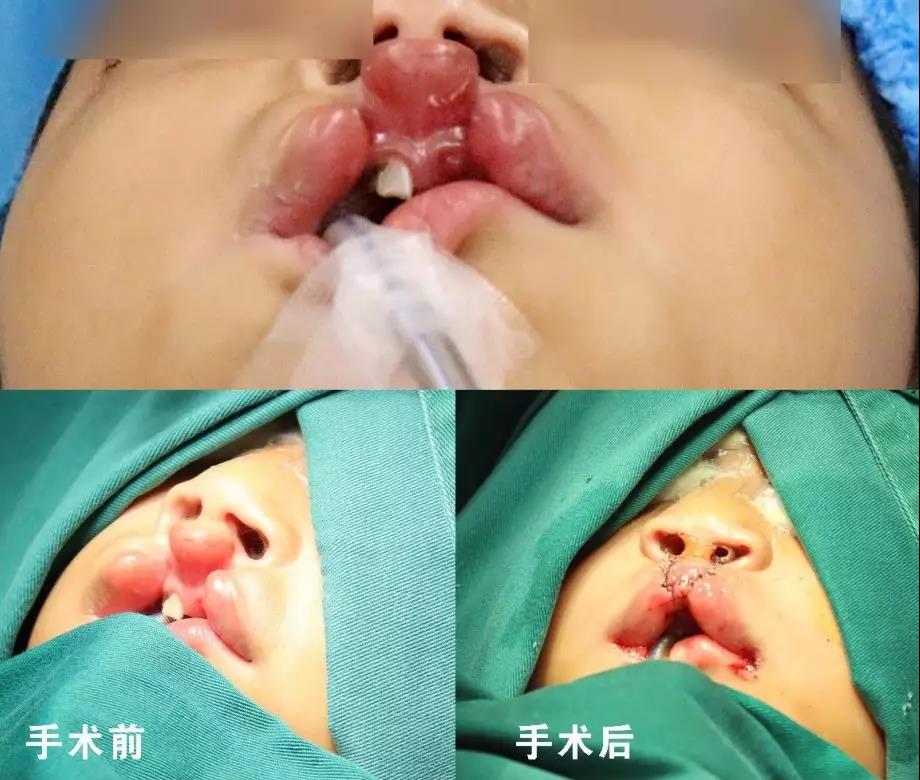 唇腭裂盡早治療消除孩子自卑心理，快樂成長！