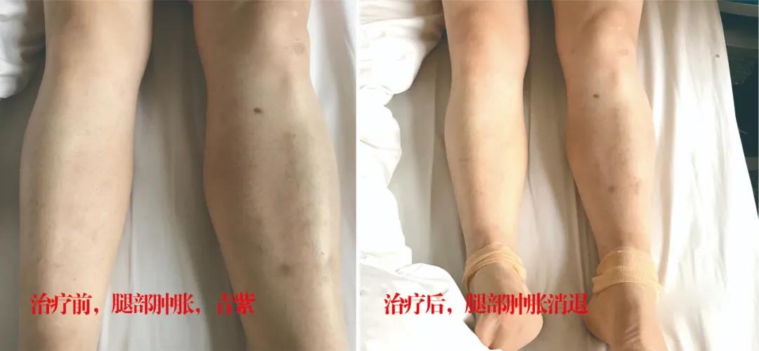 下肢靜脈血栓多年頑疾反復腫痛——疾病不容等待，早治療，早健康！
