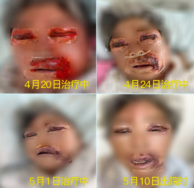 膿毒血癥（急性頜面部蜂窩組織炎）多學(xué)科聯(lián)合會(huì)診，幫助患者成功治愈！