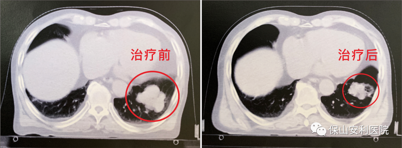 不做手術，早期肺癌也能根治！
