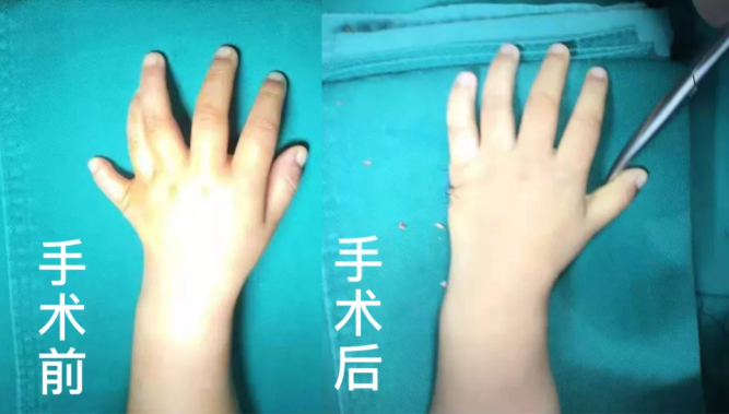 【保山安利醫(yī)院】2歲小兒手、足多指（趾）成功修復(fù)(矯正）！