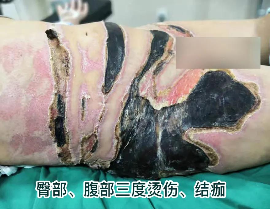 【保山安利醫(yī)院】80歲老人不慎燒傷，導(dǎo)致腹部、右側(cè)臀部大面積創(chuàng)傷，經(jīng)植皮治療創(chuàng)面逐漸愈合