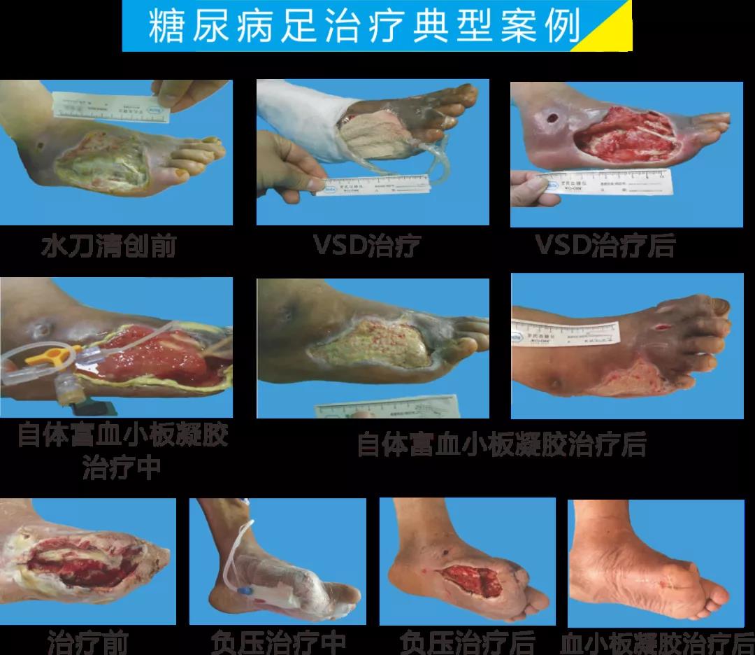 截肢、失明，甚至……，我們要做的是將糖尿病并發(fā)癥遏制在搖籃里！