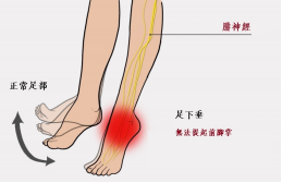 【保山安利醫(yī)院—健康科普】什么是足下垂！你了解嗎？