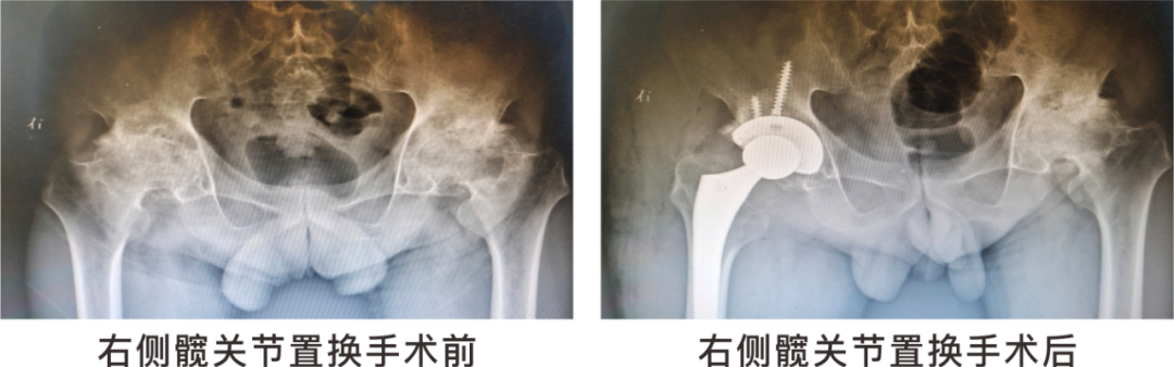 【保山安利醫(yī)院】長期飲酒導致雙側(cè)股骨頭壞死，髖關節(jié)置換后重獲運動功能！
