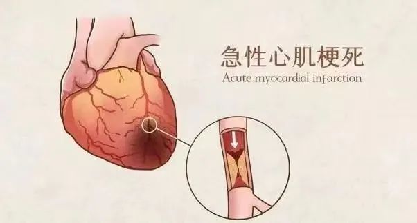 【保山安利醫(yī)院】11月20日“心梗救治日” 時(shí)間就是心肌，時(shí)間就是生命！